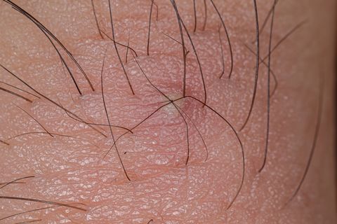 inflammation caused by ingrown hair