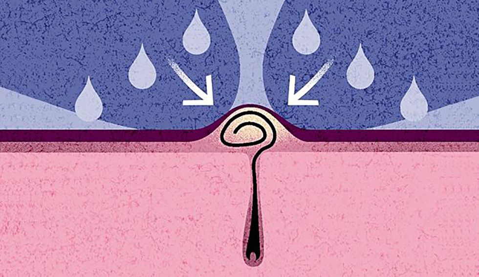 How to Get Rid of an Ingrown Pubic Hair on Your Vagina