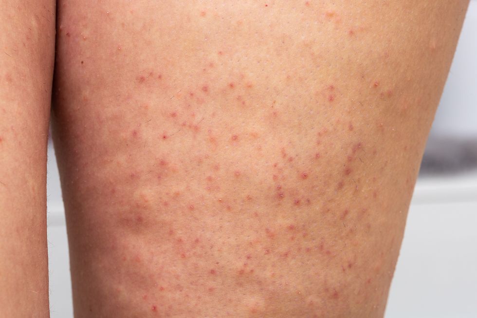 a white woman's leg with red bumps, indicating razor burn