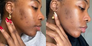 'This One Step Product Faded My Acne Scars'