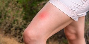 insect bite on a woman's leg
