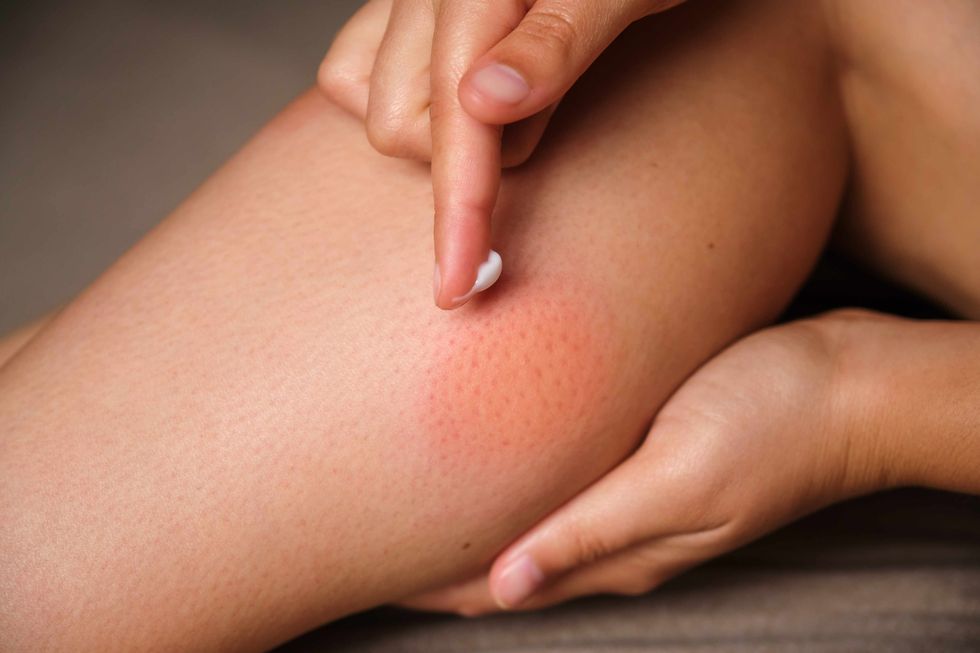 woman applying medicine cream on mosquito bite on her leg allergic reaction, itch, irritation due to insect bite concepts