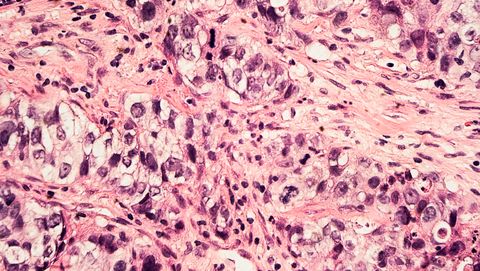 Breast Cancer: Invasive Ductal Carcinoma, Grade 3