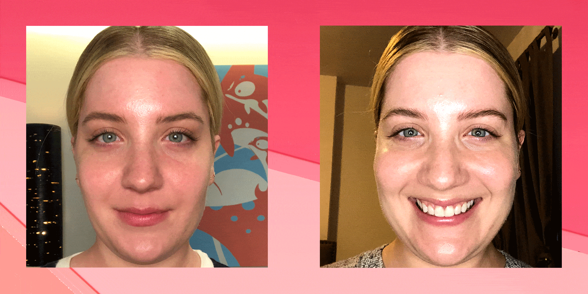 Roest pad hoofd IPL Laser for Rosacea - Here's What Happened When I Tried It