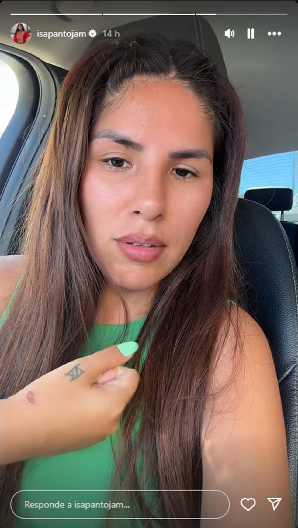 isa pantoja muestra su quemadura por un accidente domestico