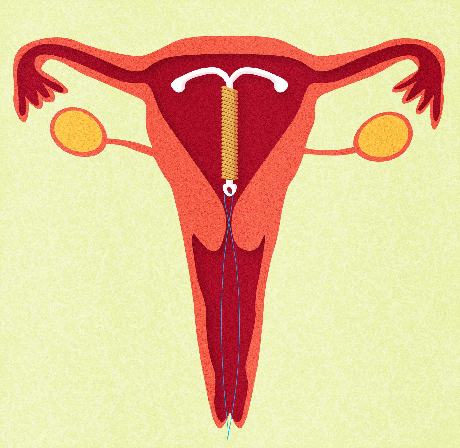 1754px x 1708px - Sex With An IUD: What You Need To Know