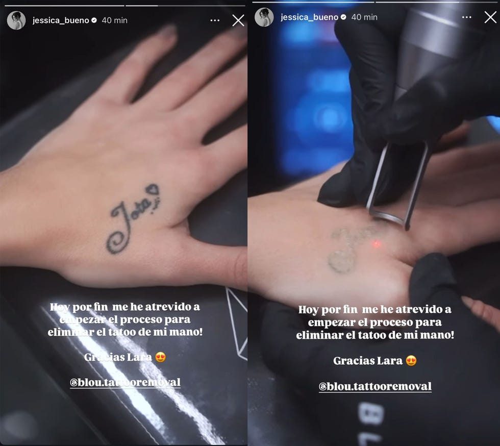 la mano de la modelo sometiendose a una sesion de laser para eliminar el tatuaje con el nombre de jota