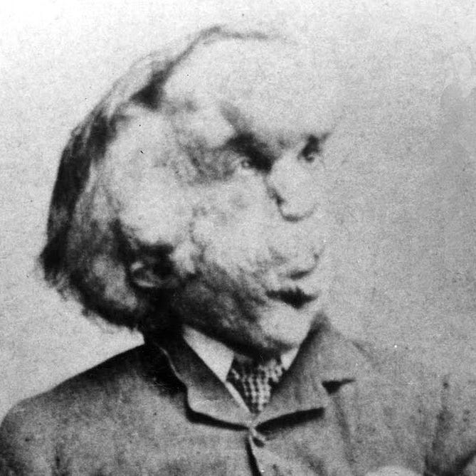 Joseph Merrick