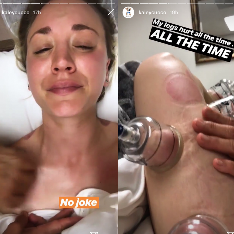 Kaley Cuoco Cupping Therapy