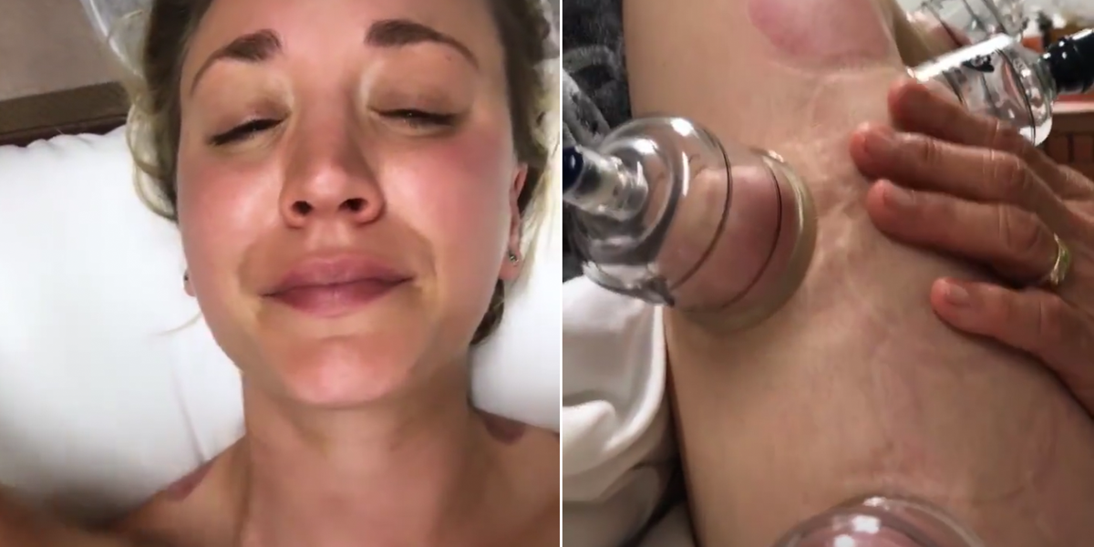 Kaley Cuoco Shares Painful Video of Cupping Therapy: Does It Work?