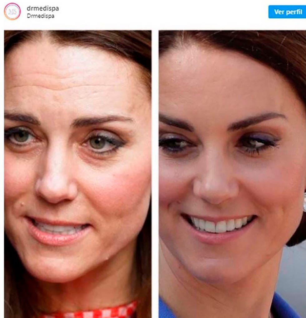 Kate Middleton, en el centro de la polémica por su supuesto uso de bótox