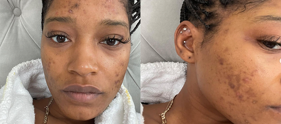 Keke Palmer Shares the PCOS Symptoms She Experiences