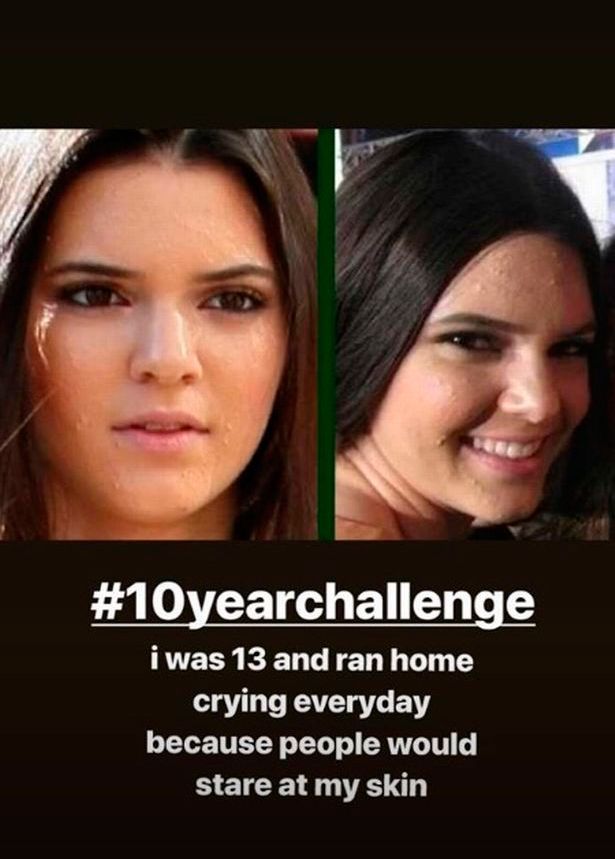 Kendall Jenner Acne