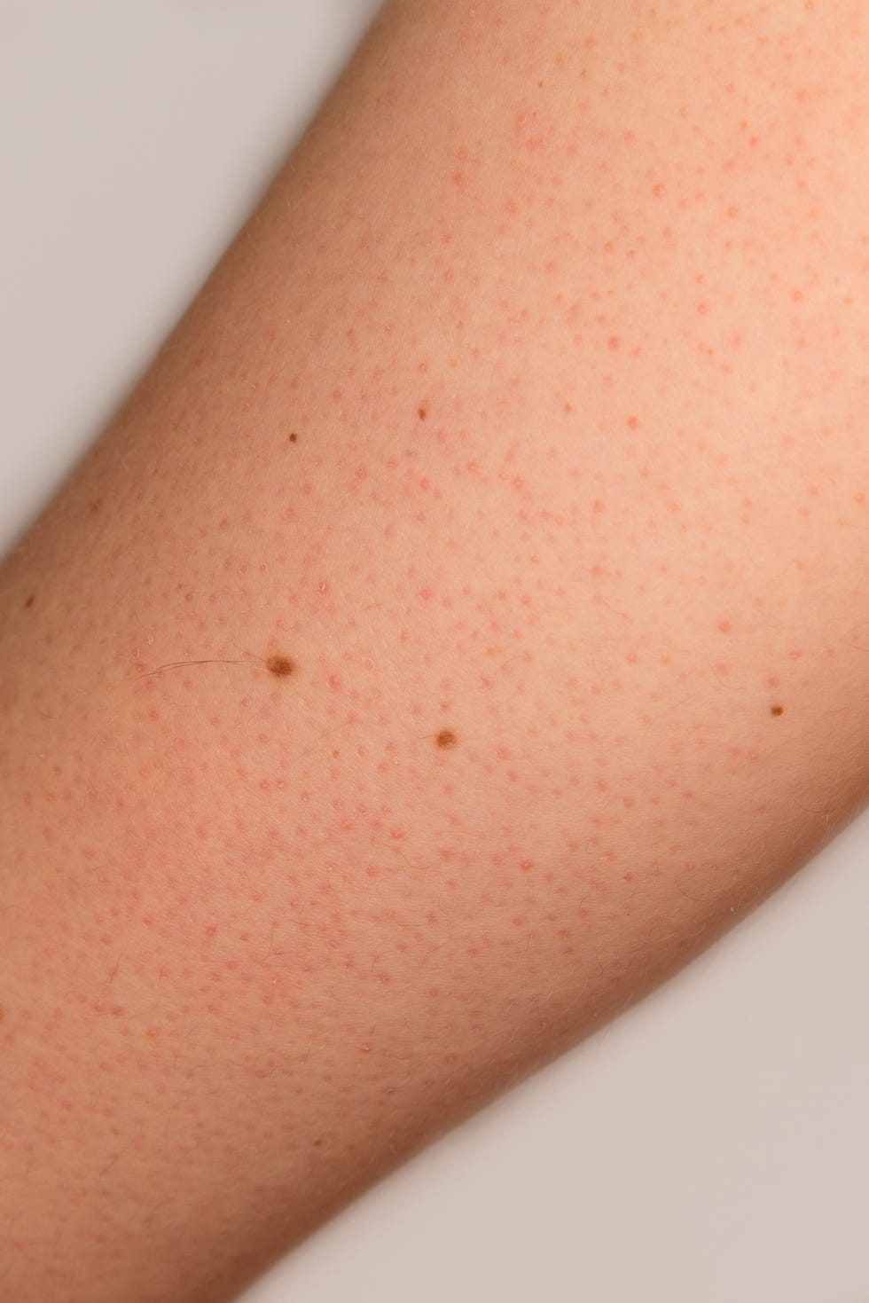 keratosis pilaris