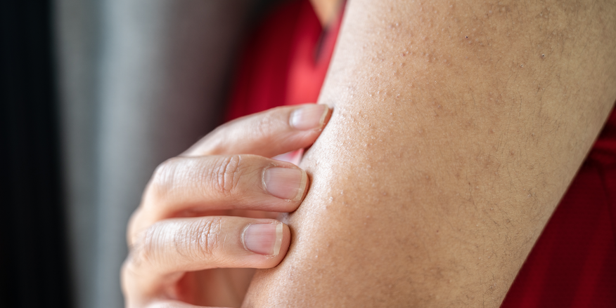 close up of keratosis pilaris symptoms on mens arm