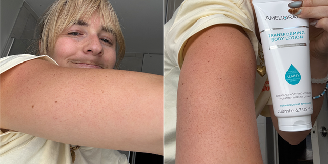 keratosis pilaris treatment