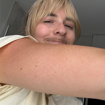 keratosis pilaris treatment keratosis pilaris treatment