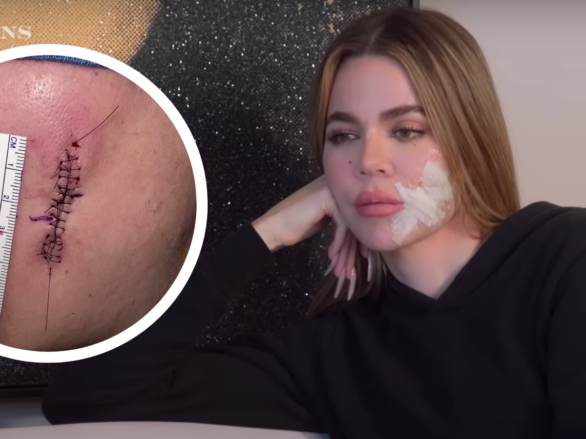 tolerance eftermiddag Møntvask Khloe Kardashian shows off huge scar after having melanoma removed from her  face