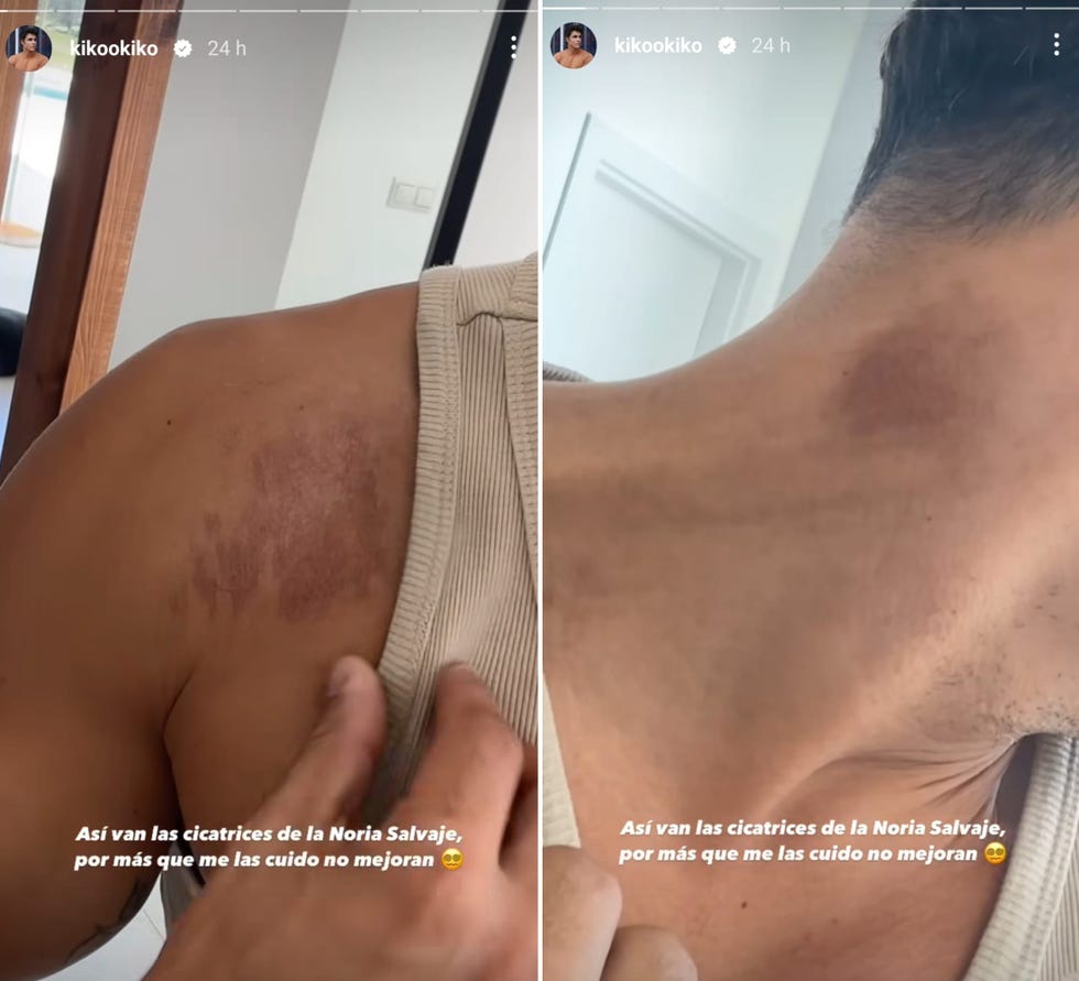 kiko jimenez muestra sus cicatrices tras su accidente en la noria infernal de supervivientes