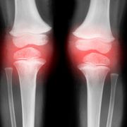 x ray of knees with arthritis inflamed knees red