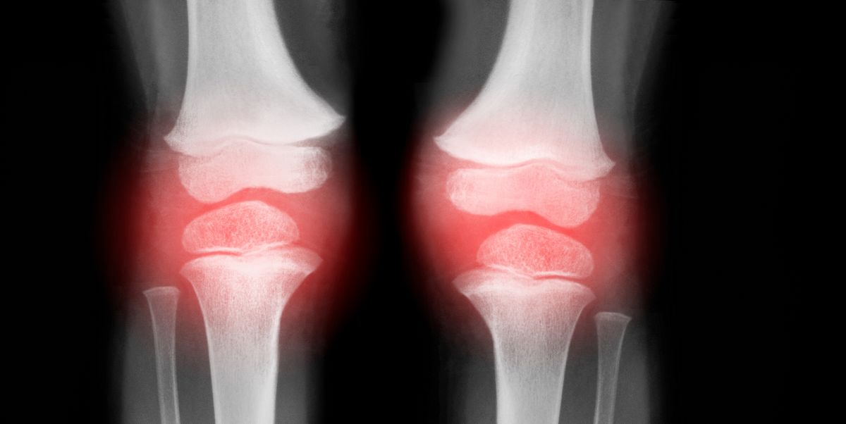 Doctors Explain Knee Arthritis—Including Symptoms, Types, and Treatments