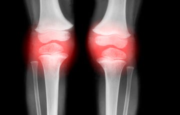 knees with arthritis