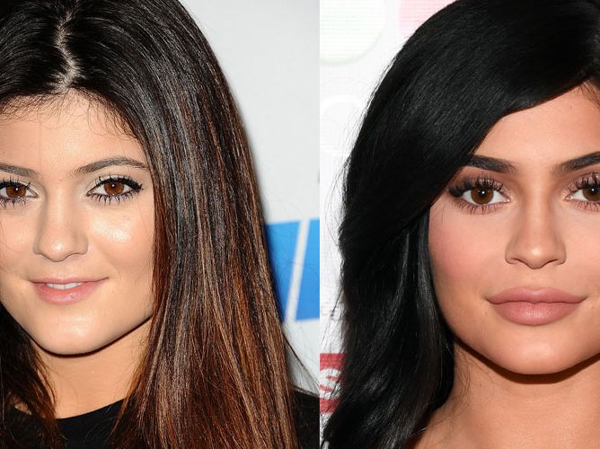 Plastic surgery before and after - 9 celebrities on what it's really like