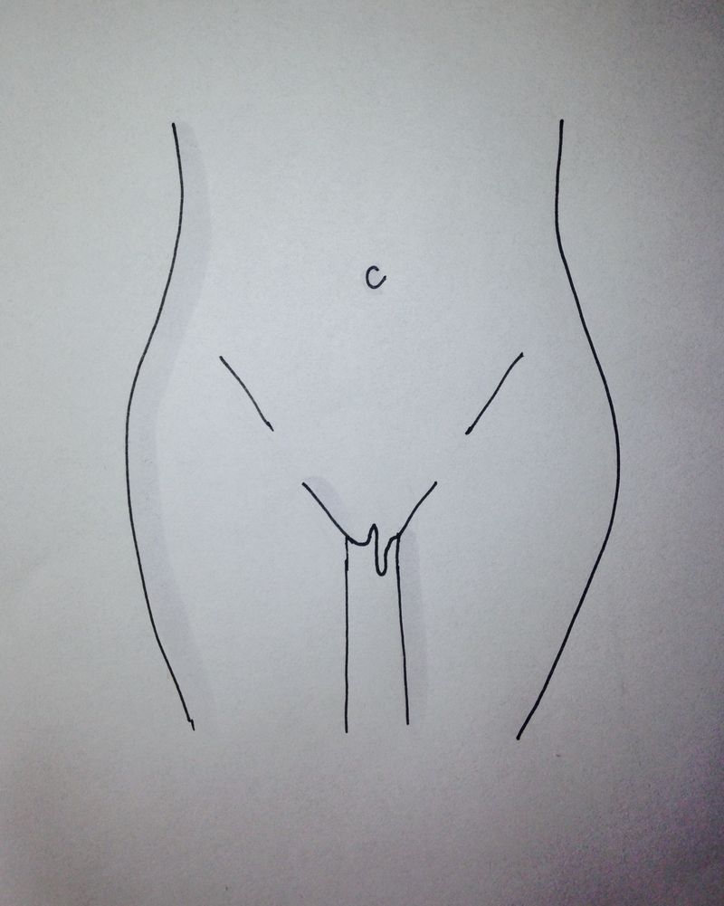 an illustration of a vagina that has asymmetrical inner lips is where one side of the labia minora is longer than the other, and hangs down a little past the labia majora