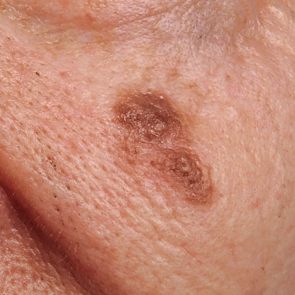a large mole on skin