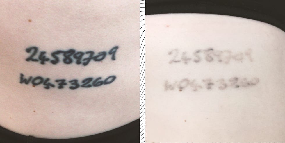 laser tattoo removal picosure review