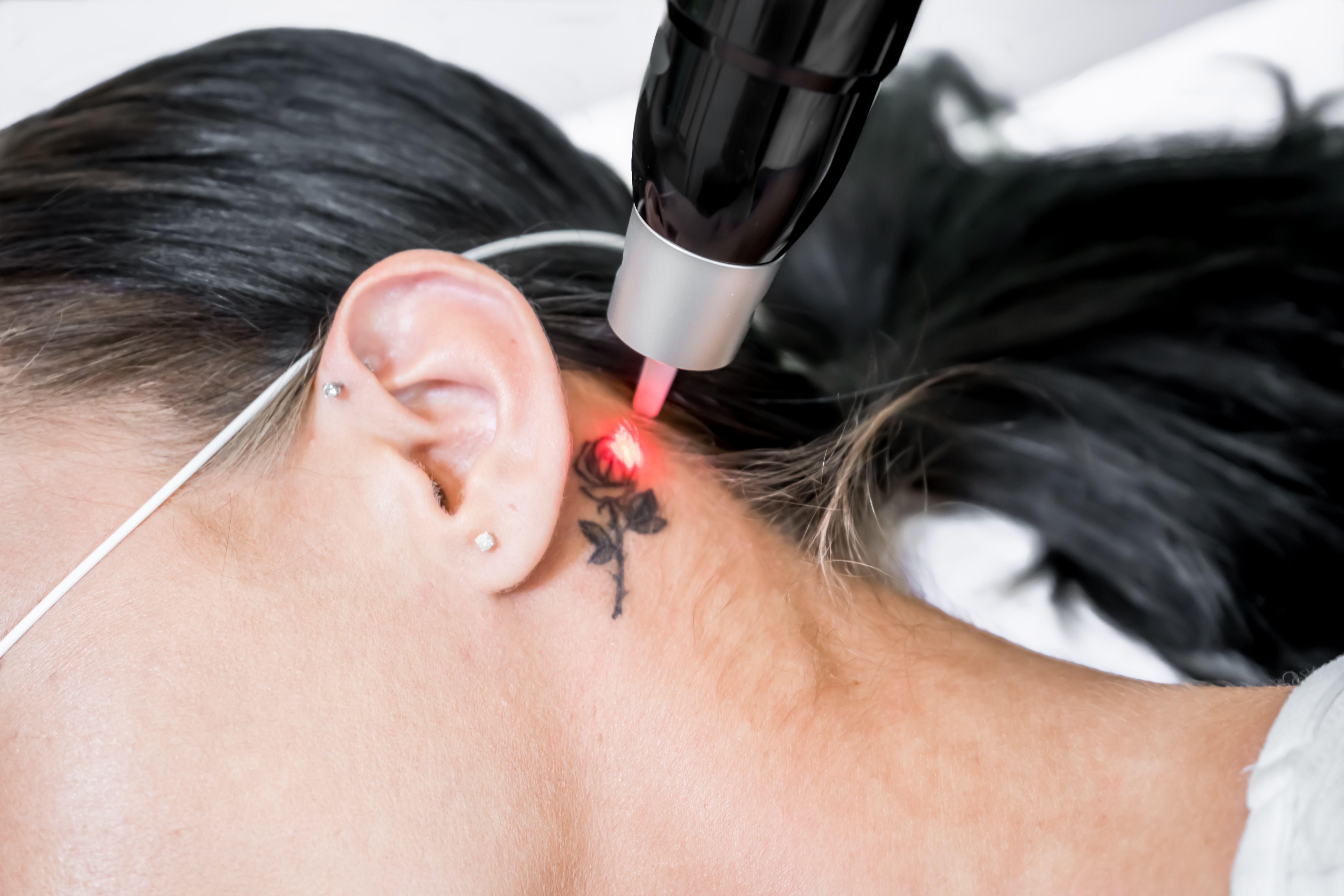 Your Guide to Laser Tattoo Removal | Dermedica