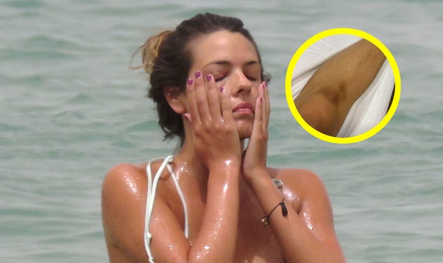 laura matamoros sufre un doloroso golpe que acaba en moretón en la rodilla