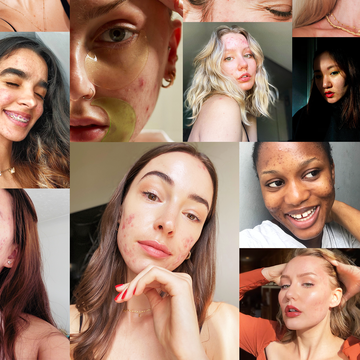 acne positive influencers