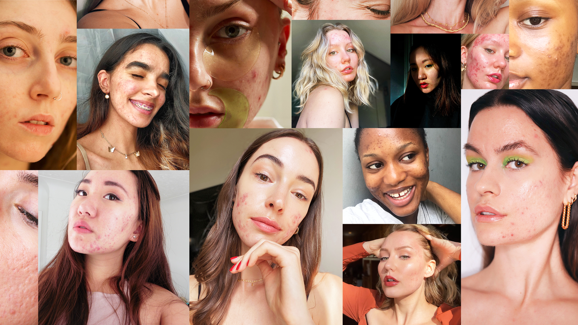 acne positive influencers