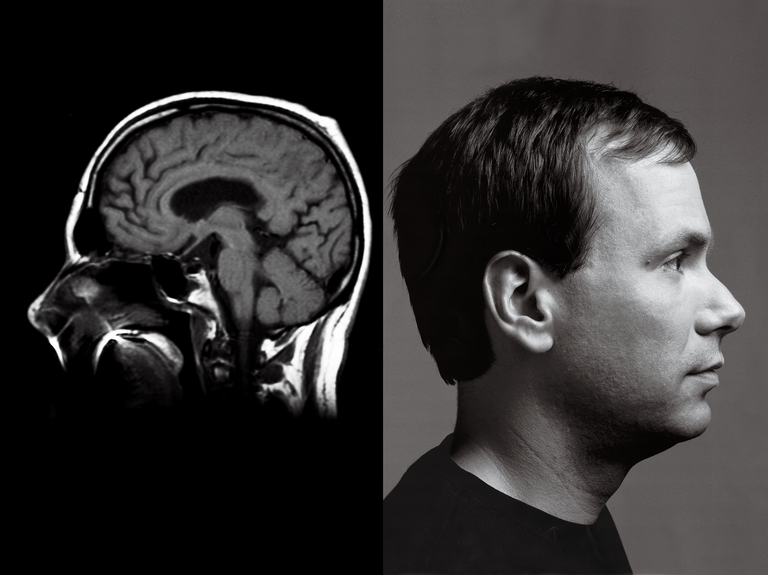 diptych of a brain scan and profile photo