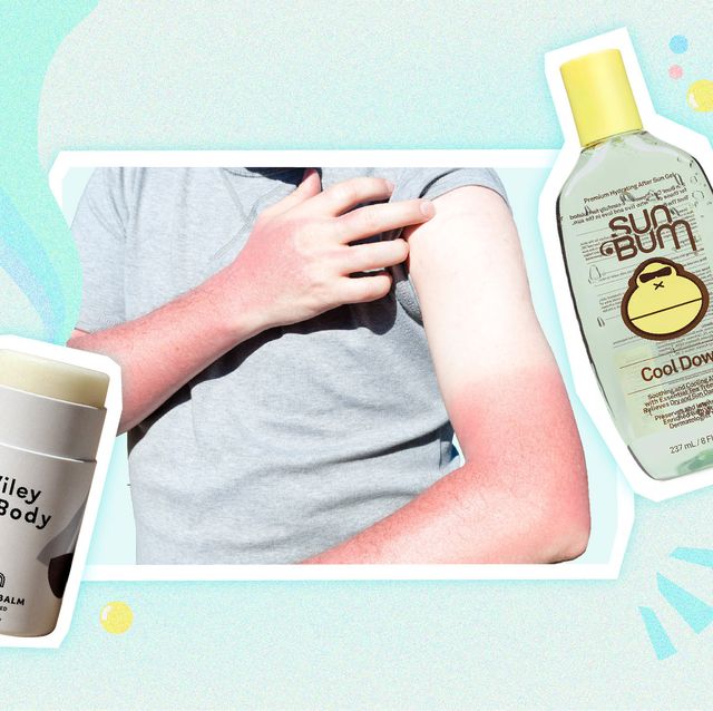 How to Treat Sunburn the Right Way, According to Experts