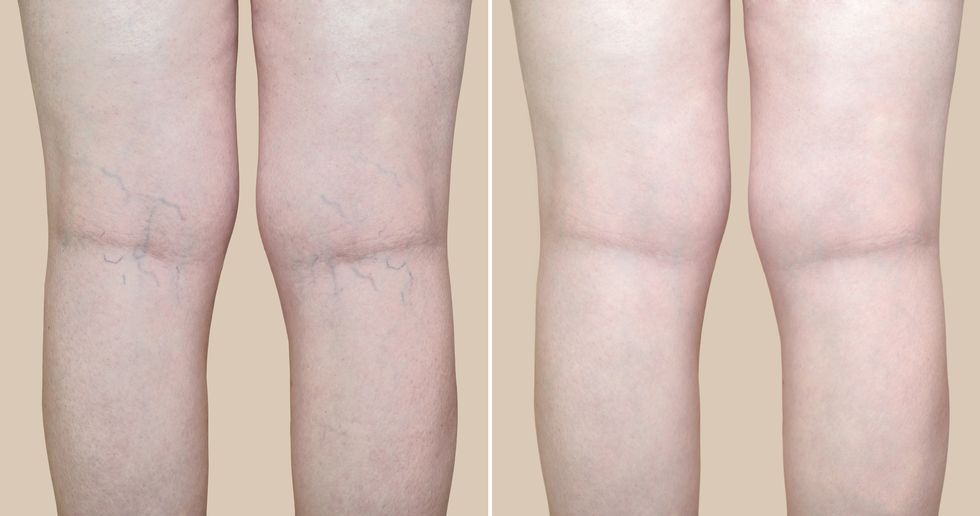 legs of a woman with varicose veins and capillaries before and after medical treatment