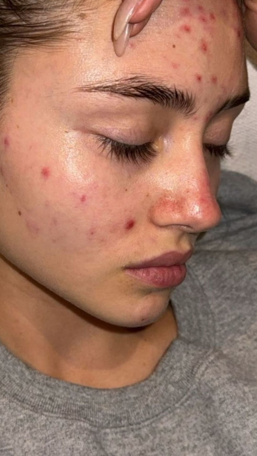 leni klum muestra su rostro con acné