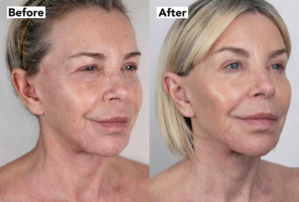 leslie ash 10 years younger facelift