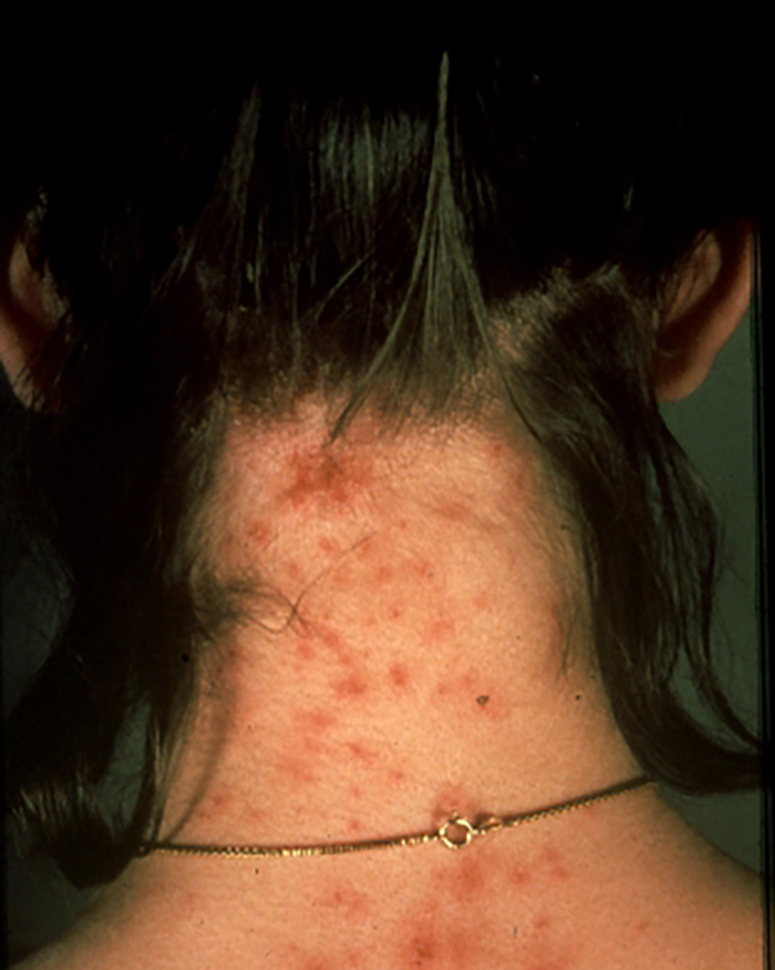 body lice skin