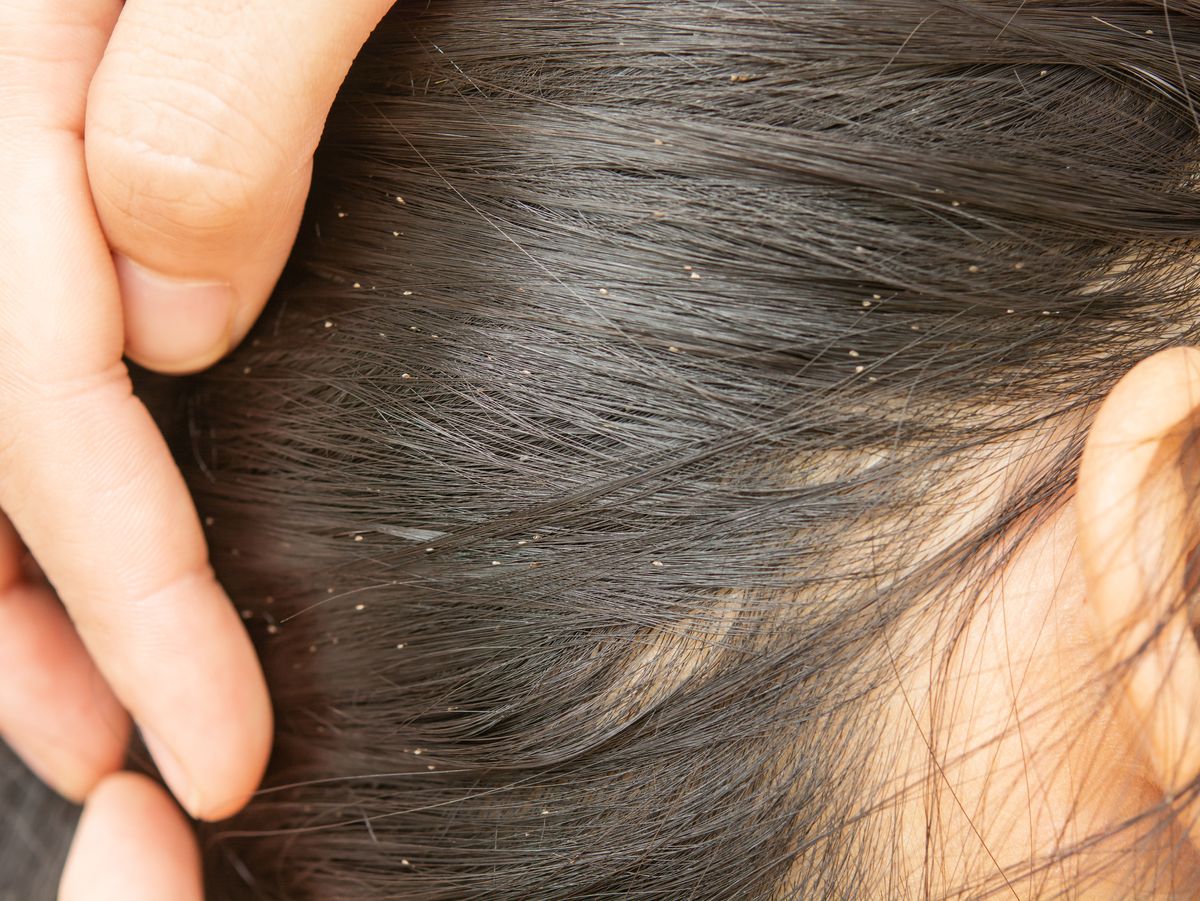 7 Common Signs of Lice - Head Lice Symptoms & Treatment