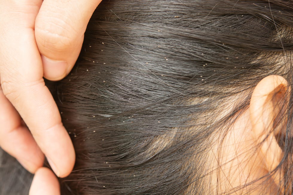 lice in hair