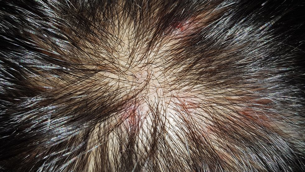 red bumps on the scalp