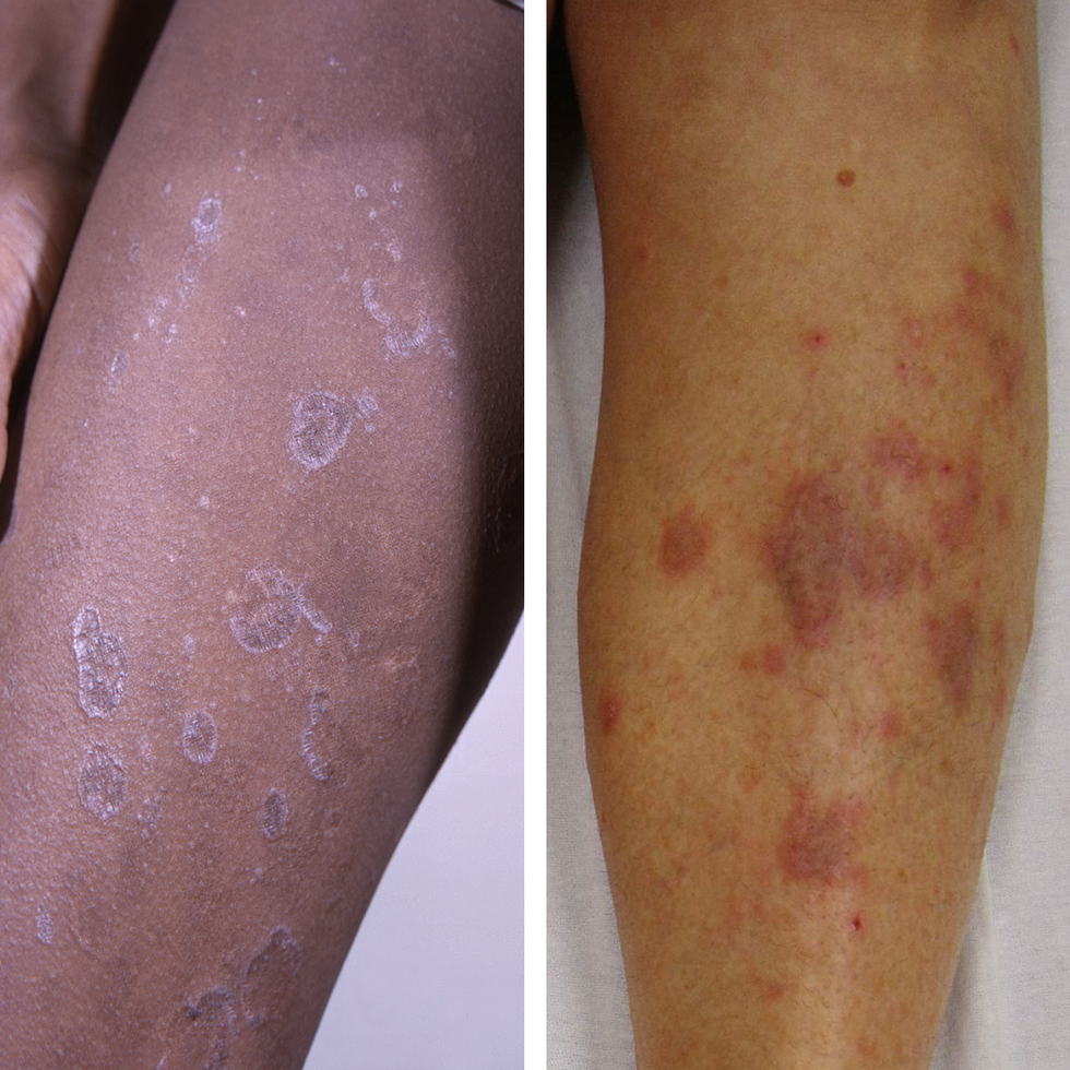 Latex allergy skin rash - Stock Image - C047/8448 - Science Photo