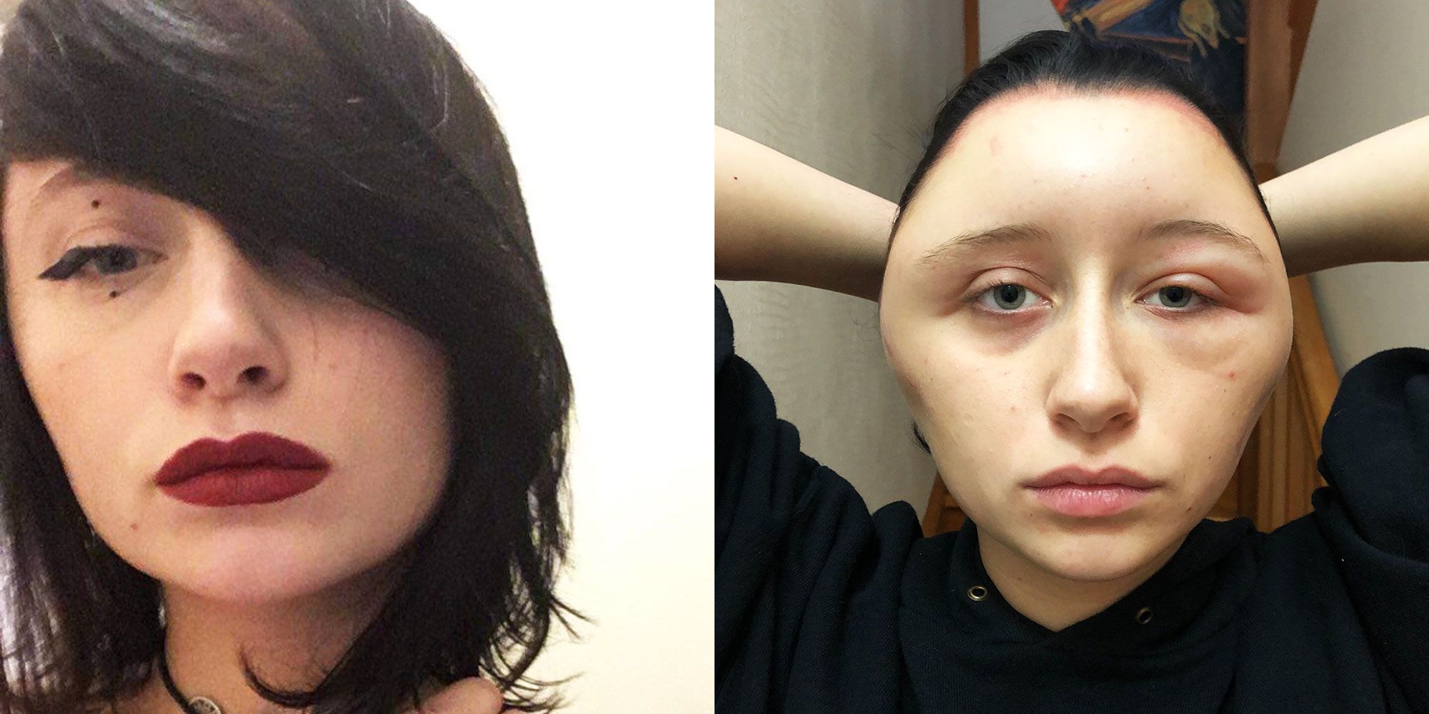 Woman Had Severely Swollen Head After Allergic Reaction To Hair photo