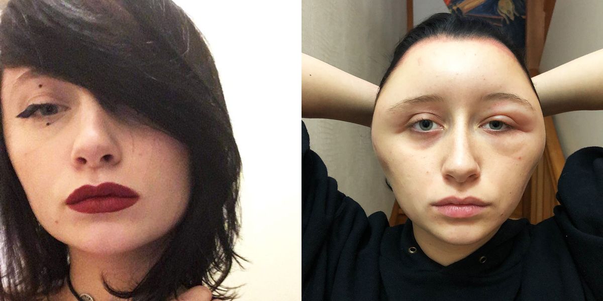 Woman Had Severely Swollen Head After Allergic Reaction To Hair Dye