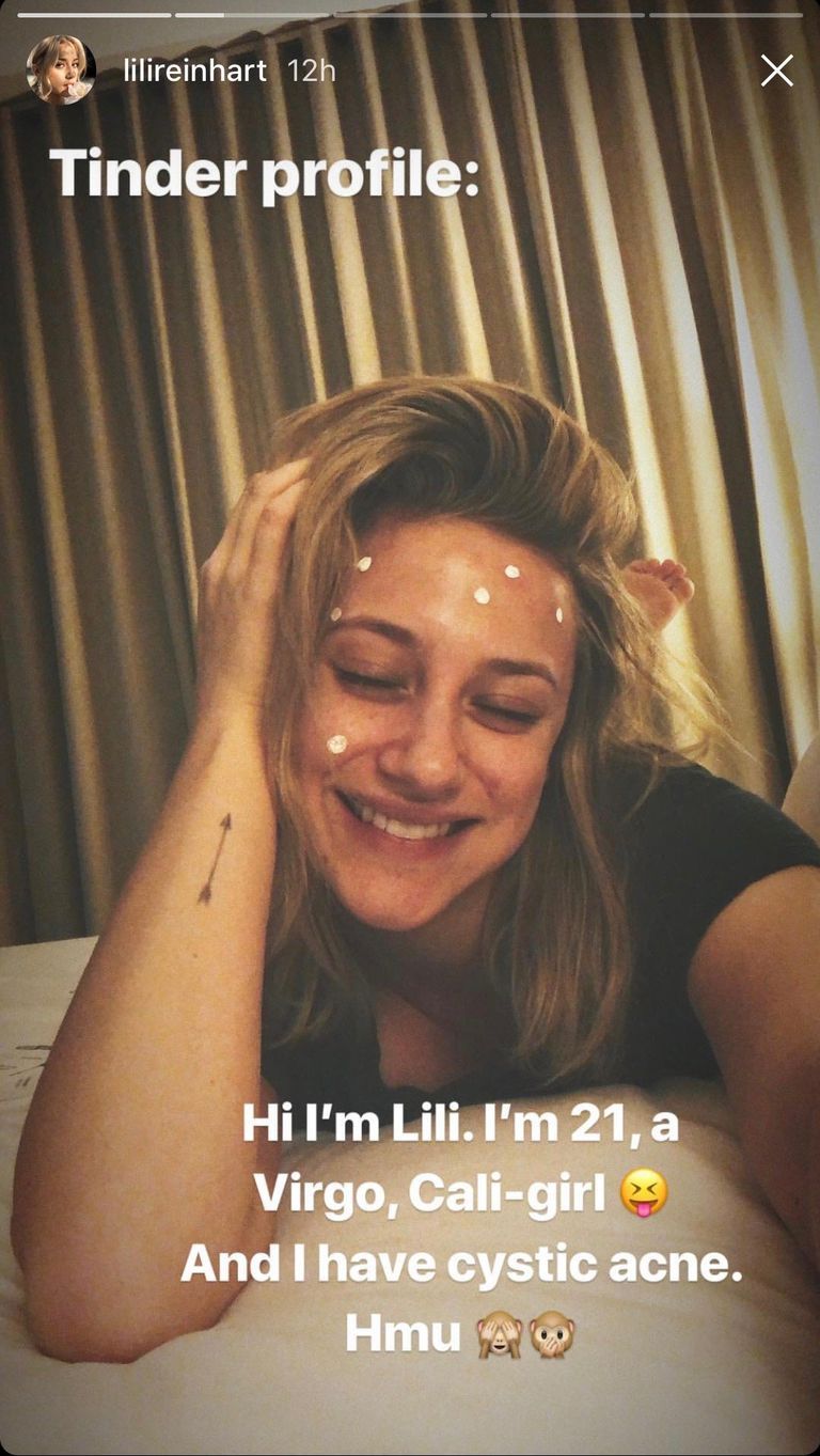 Lili Reinhart Instagram stories cystic acne tinder profile