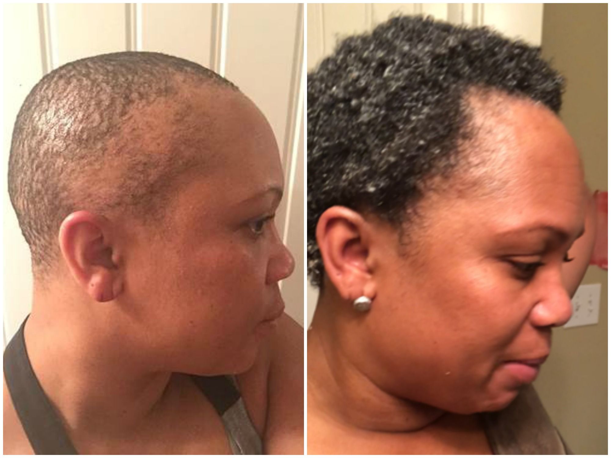 This Woman Turned Traction Alopecia Into a Lesson In Self-Care