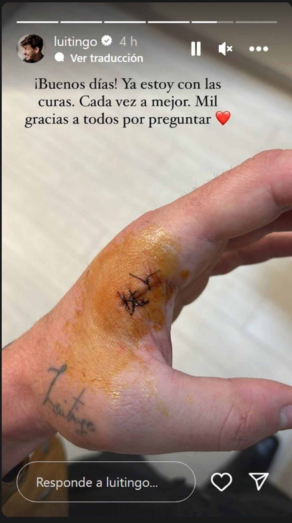 la mano de luitingo, herida