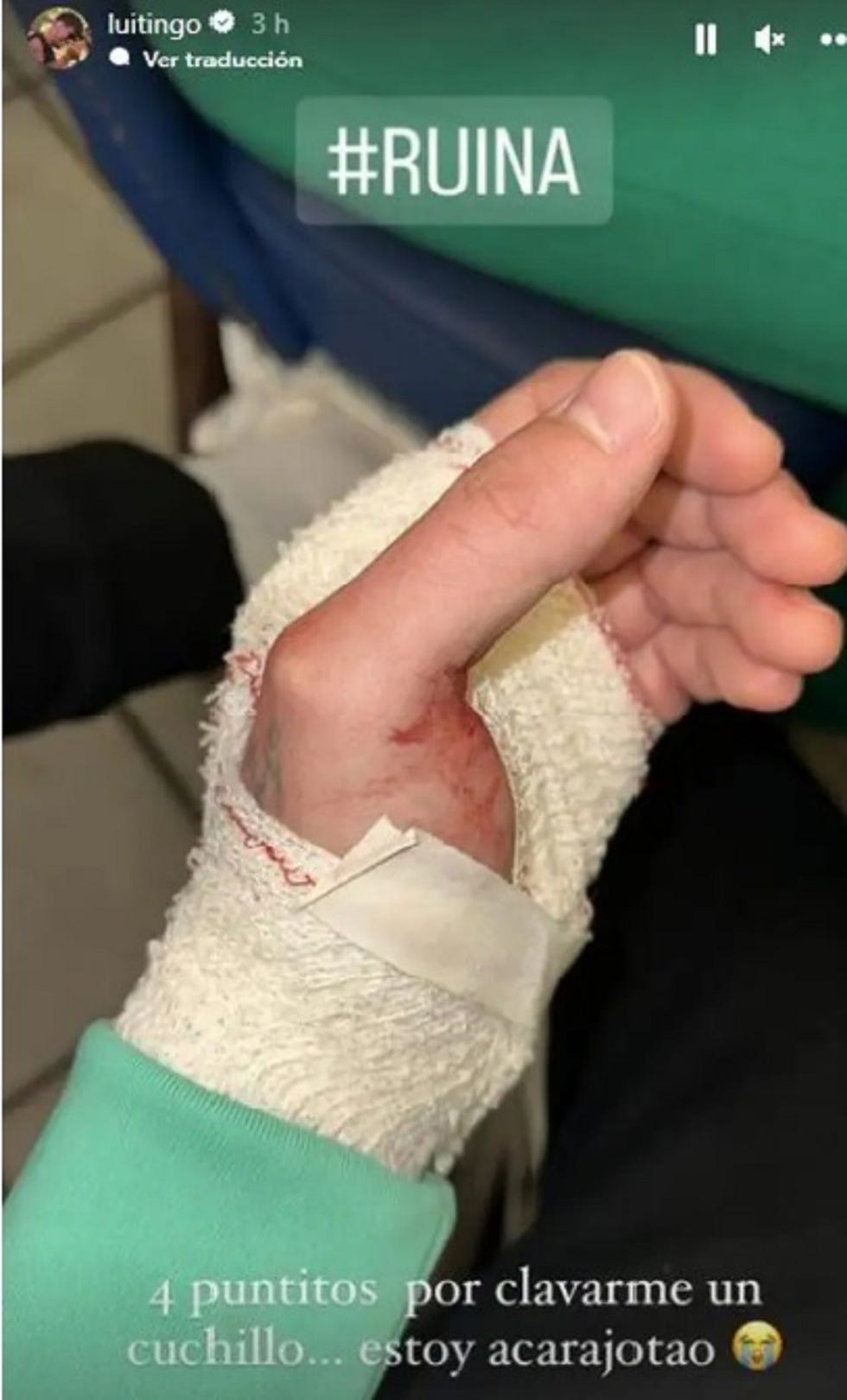 luitingo con la mano cortada